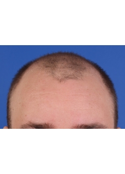 Before Hair Transplant&nbsp;Front